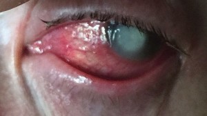 φακούς επαφής 3