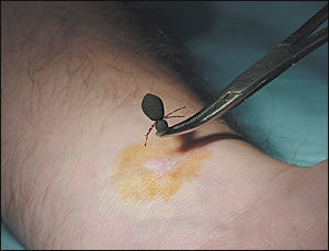 tick-removal-2